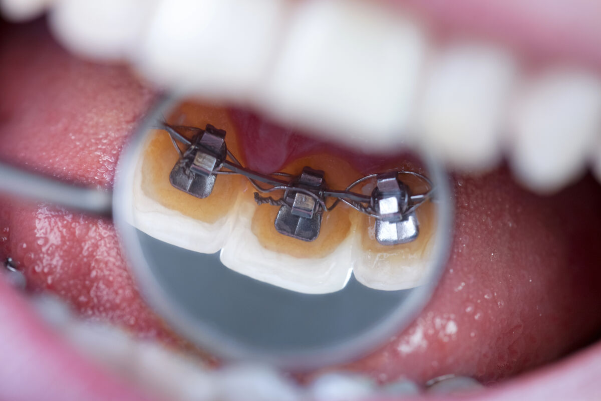 Invisalign vs appareils dentaires traditionnels : Quelle différence ?